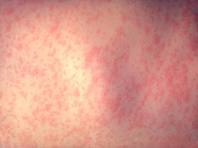 Rock County Investigates Five Probable Measles Cases in One Family