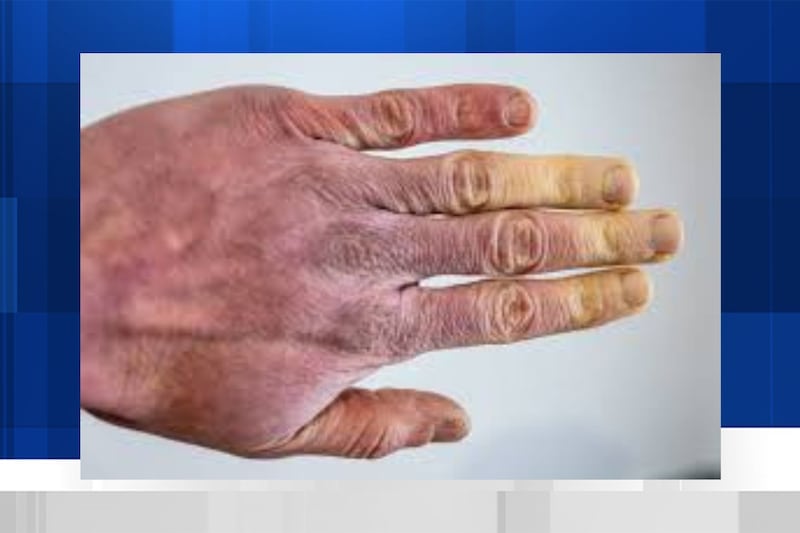 Medical experts share frostbite tips and how to prevent it