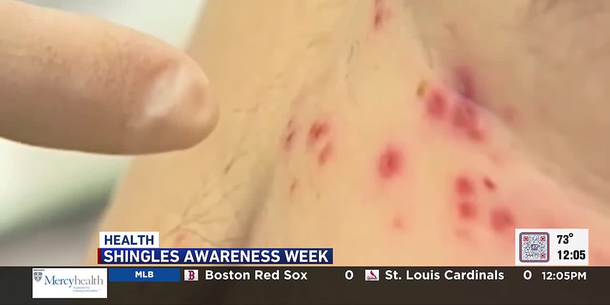 What You Need To Know About Shingles what-you-need-to-know-about-shingles